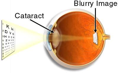 What is Cataract